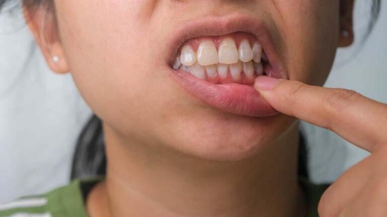 Beyazlatma işleminde yanlış uygulama diş kaybına neden olabilir
