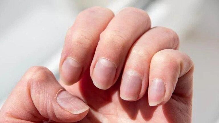 Tırnakların sağlığına ilişkin haberler … Hangi doktor çiviye gidebilir? Tırnak hastalıklarına hangi bölüme bakar?
