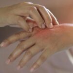 Egzama nedir? Egzama belirtileri, nedenleri ve etkili tedavi yöntemleri