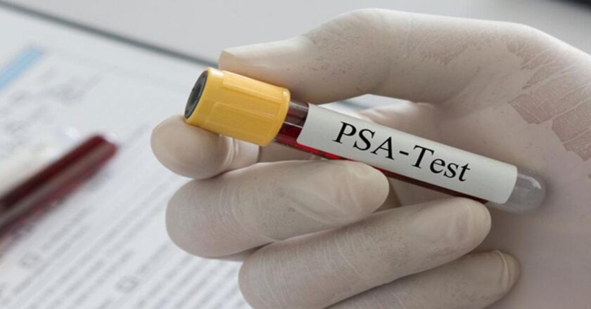 PSA testi nedir, ne yapar? Yüksekliği ve yüksekliği ne anlama geliyor?