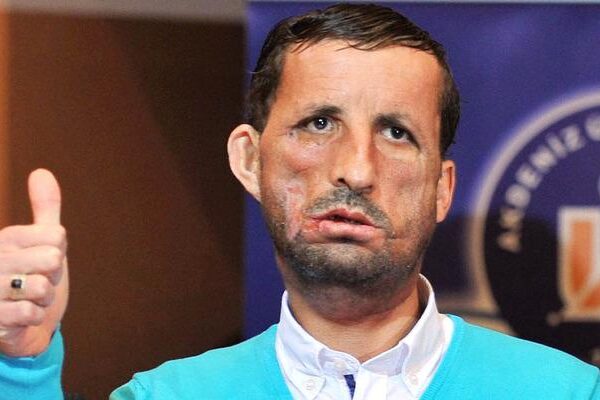 “Birincinin Merkezi” 50’de organ nakli temelinde yeni bir tane ekledi: akciğer nakli …