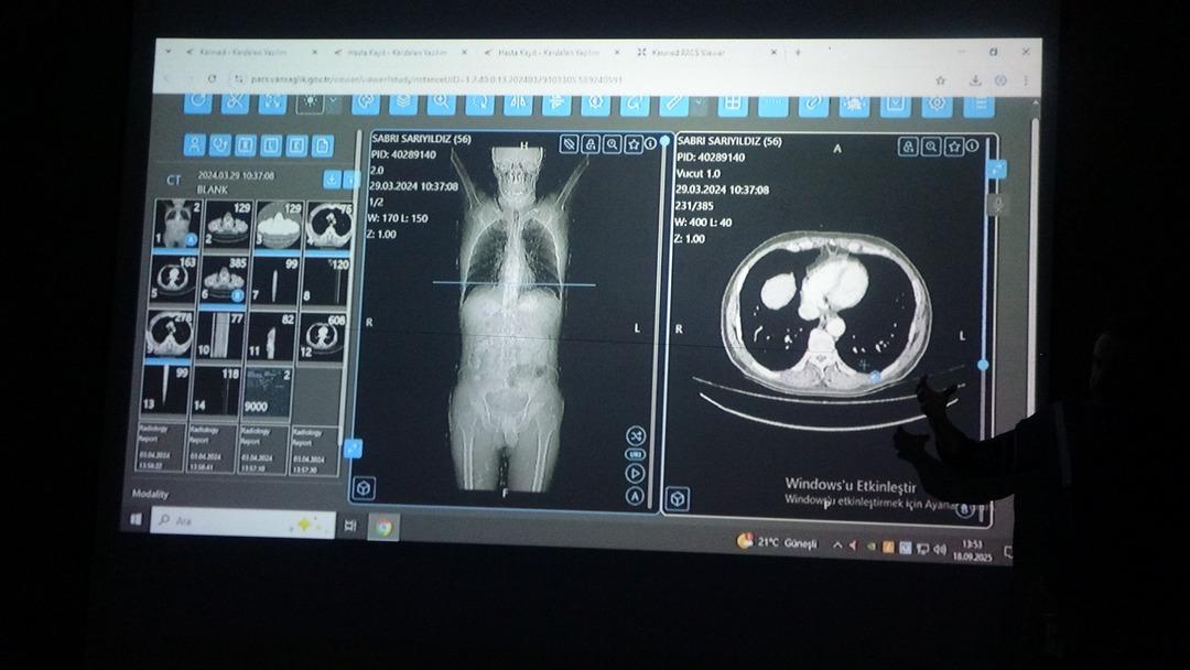 Dünya için bir örnekti! Türkiye'de birincisi: Kanser tedavisinde yapay zeka kullanıldı 4