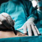 Liposuction nedir, nasıl yapılır? Liposuction tedavisi hangi durumlarda?