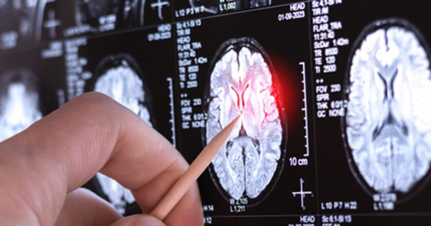 Çok nadir görülen yeni bir nörolojik hastalık keşfedildi: Sadece 13 kişide görüldü!