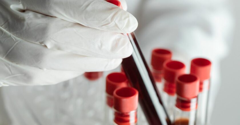 Dünyada sadece 50 kişide var! “Altın kan”ın sırrı çözüldü: Tek bir damlası bile bir servete bedel!