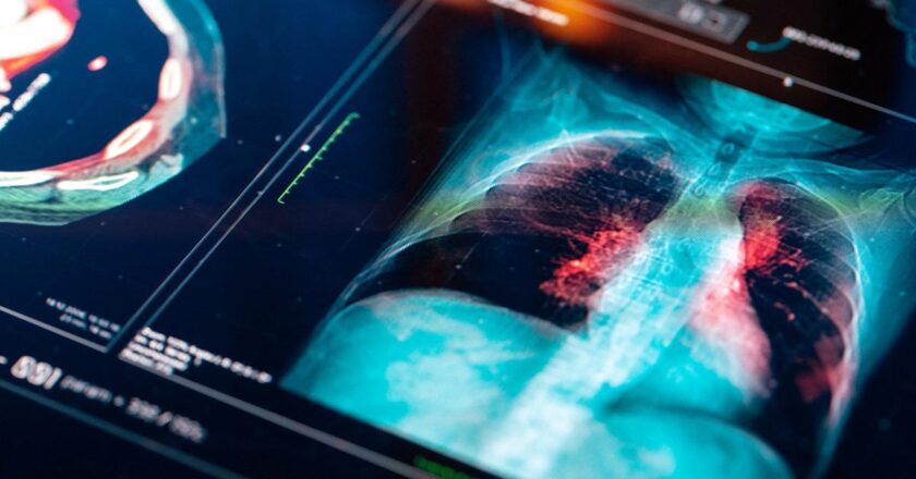 Türkiye’de her yıl 45 bin yeni vaka! Bu illerde dikkatli olun: Risk daha yüksek!