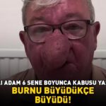 Burnu giderek büyüdü! 68 yaşındaki adam kabusunu yaşadı! 4 saat süren operasyonla adeta yeniden doğdu